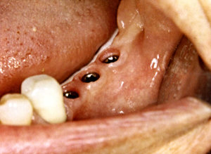 Zahnverlust im Unterkiefer