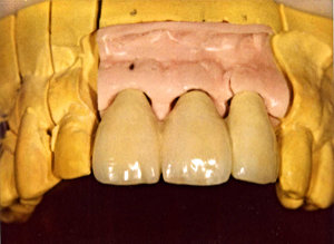 Festsitzender Zahnersatz aus dem zahntechnischen Labor