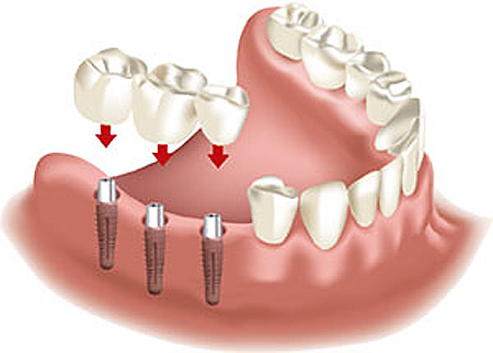 Implantat Zahn Modell