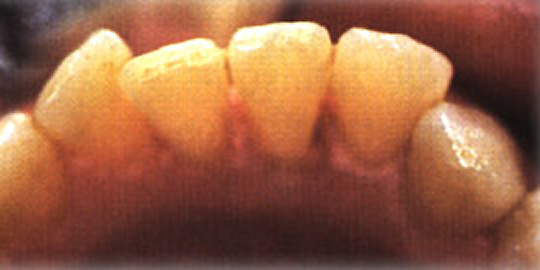 Kosmetische Zahnbehandlung nach der Behandlung