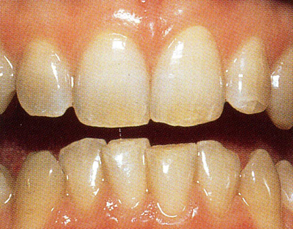 Kosmetische Zahnbehandlung vor der Behandlung