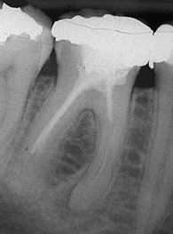 Zahn mit unvollständiger Wurzelbehandlung